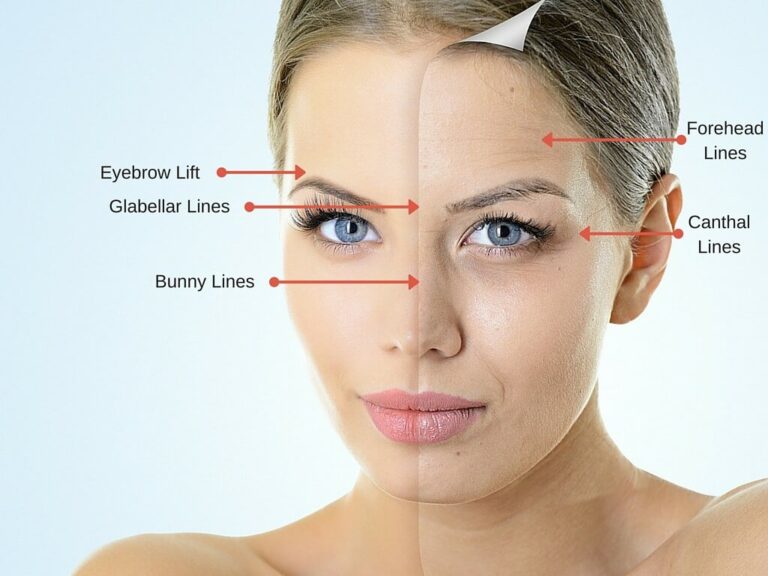 Threading Frown Line Frown Lines – The Perfect Skin Clinic